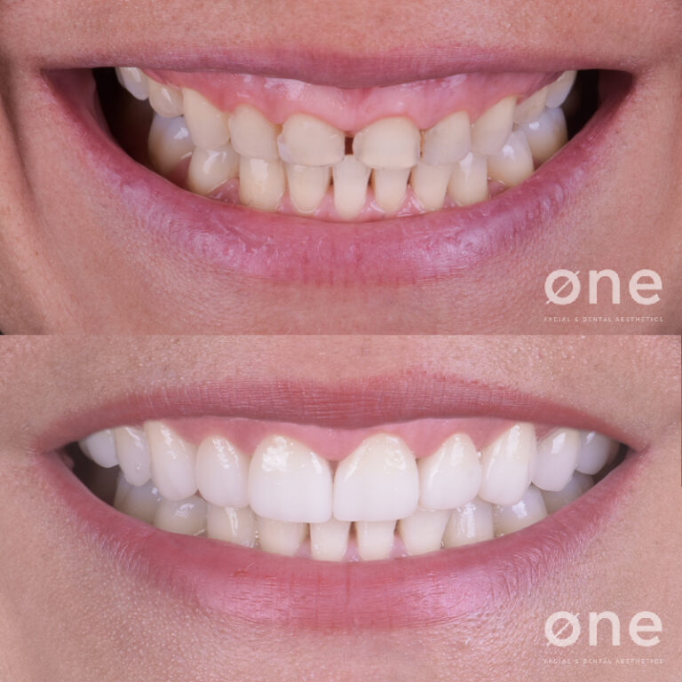 Tratamientos dentales para mejorar tu sonrisa este verano