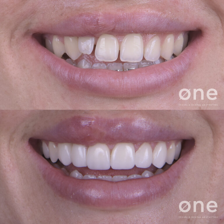 Tratamientos dentales para mejorar tu sonrisa este verano