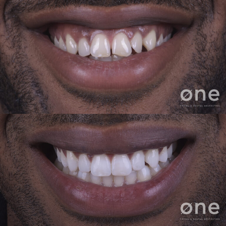 Tratamientos dentales para mejorar tu sonrisa este verano
