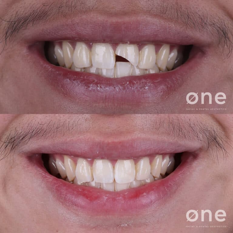 Antes-vs-Despues-reconstrucción