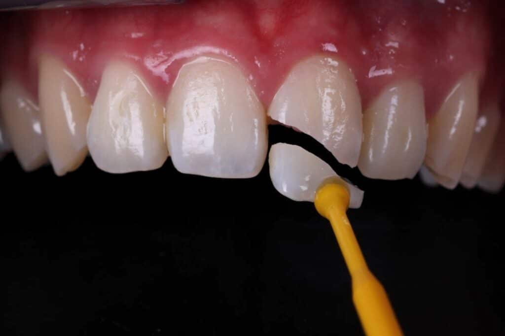 Urgencias dentales en Marbella