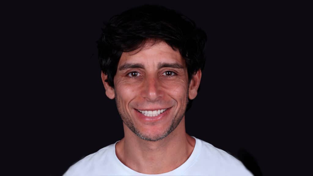 Smile makeover Marbella