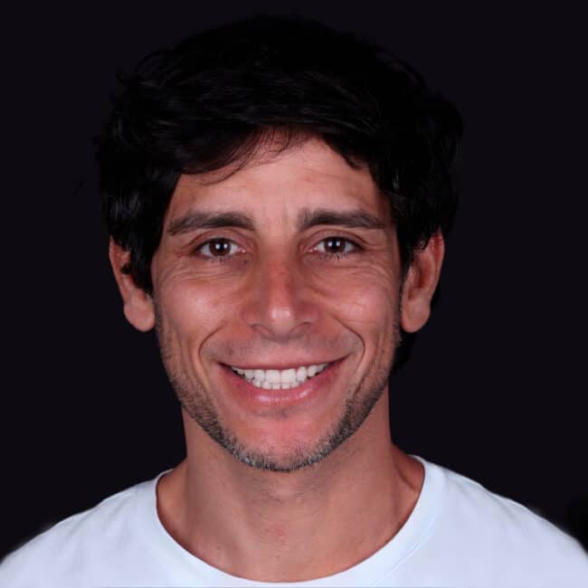 Smile makeover Marbella
