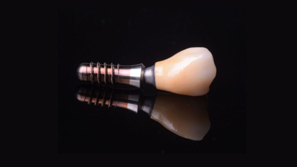 Implantes Dentales