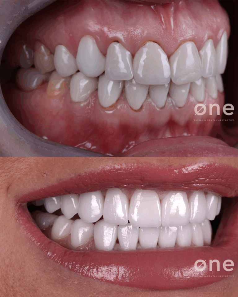 carillas dentales en una sola cita