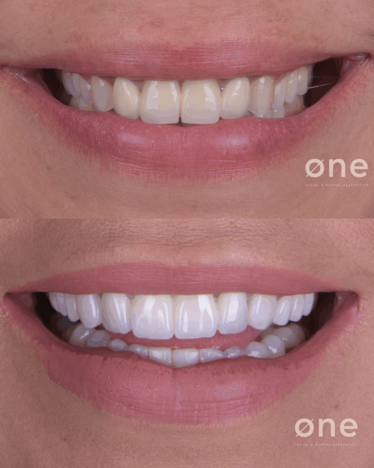 Antes y Después Carillas Dentales