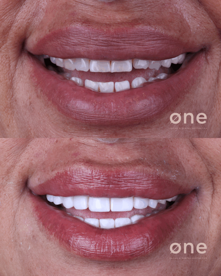 carillas dentales en una sola cita