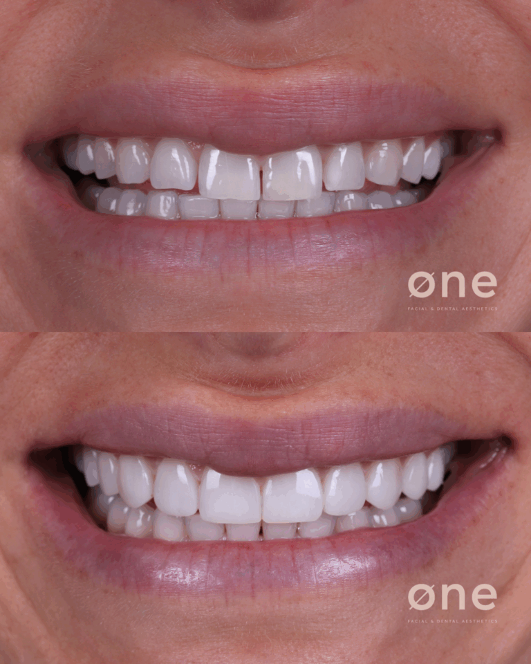 Antes y Después Carillas Dentales