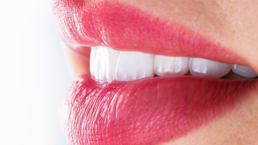 Carillas Dentales en una Sola Cita