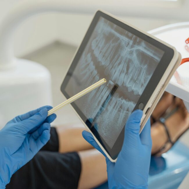 Mejor clínica dental en Marbella para implantes dentales