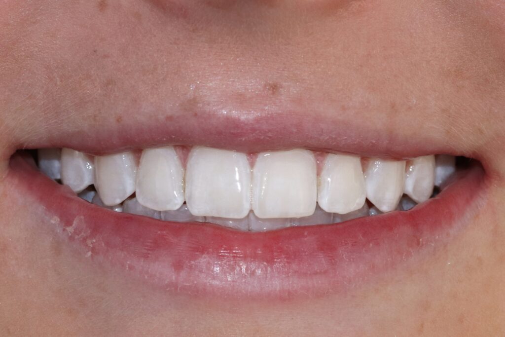 Antes