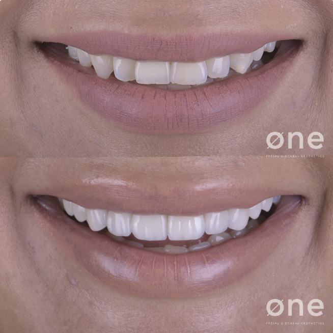 Tratamientos dentales para mejorar tu sonrisa este verano