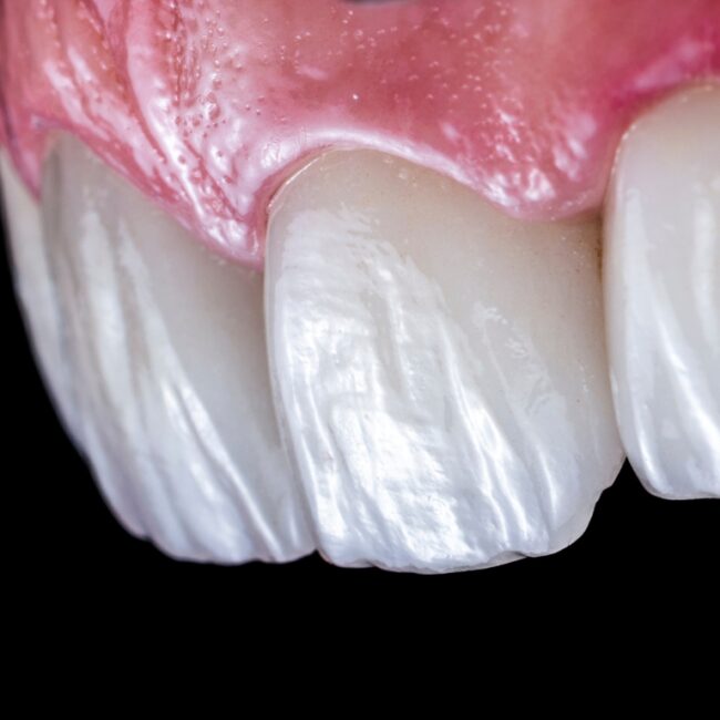 Carillas de porcelana o composite