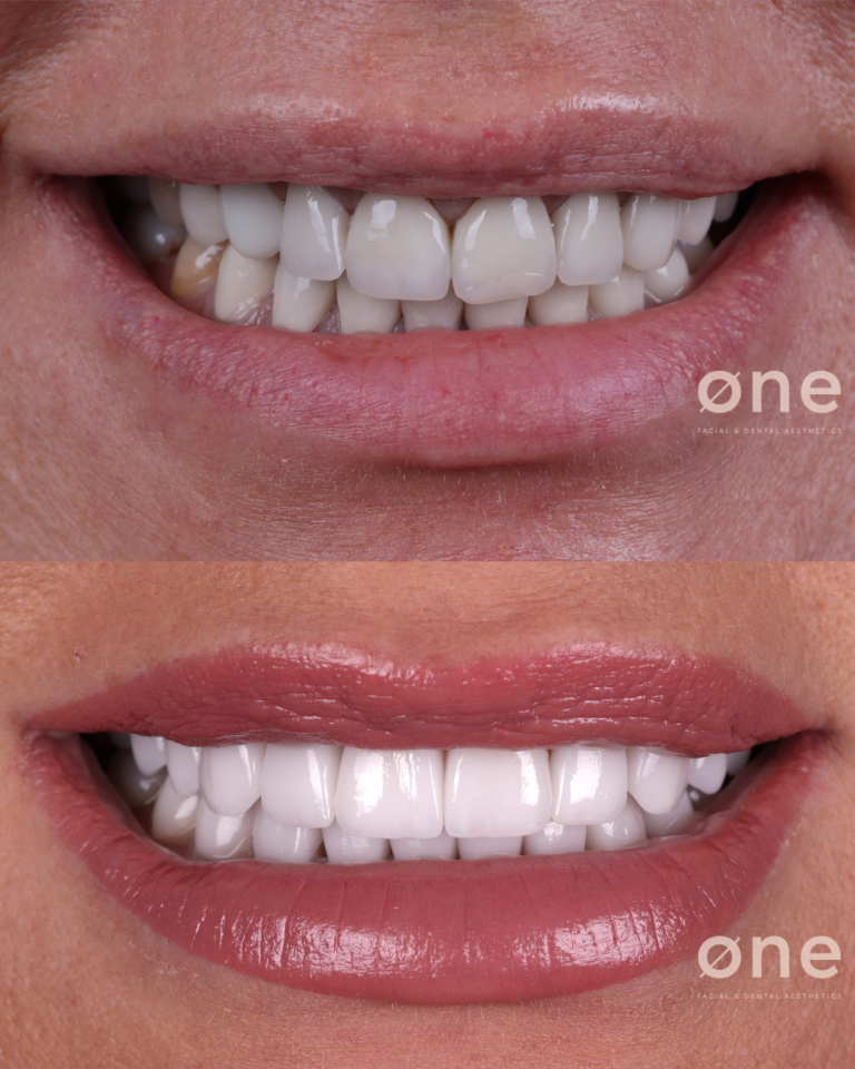 Porcelain or composite veneers
