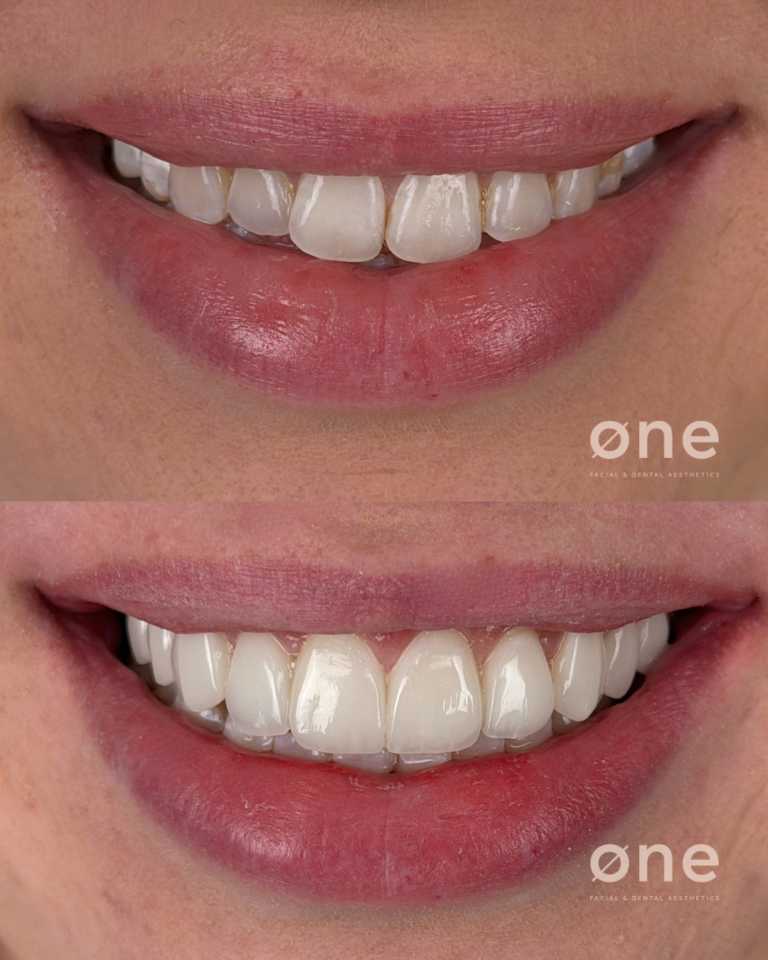 Porcelain or composite veneers